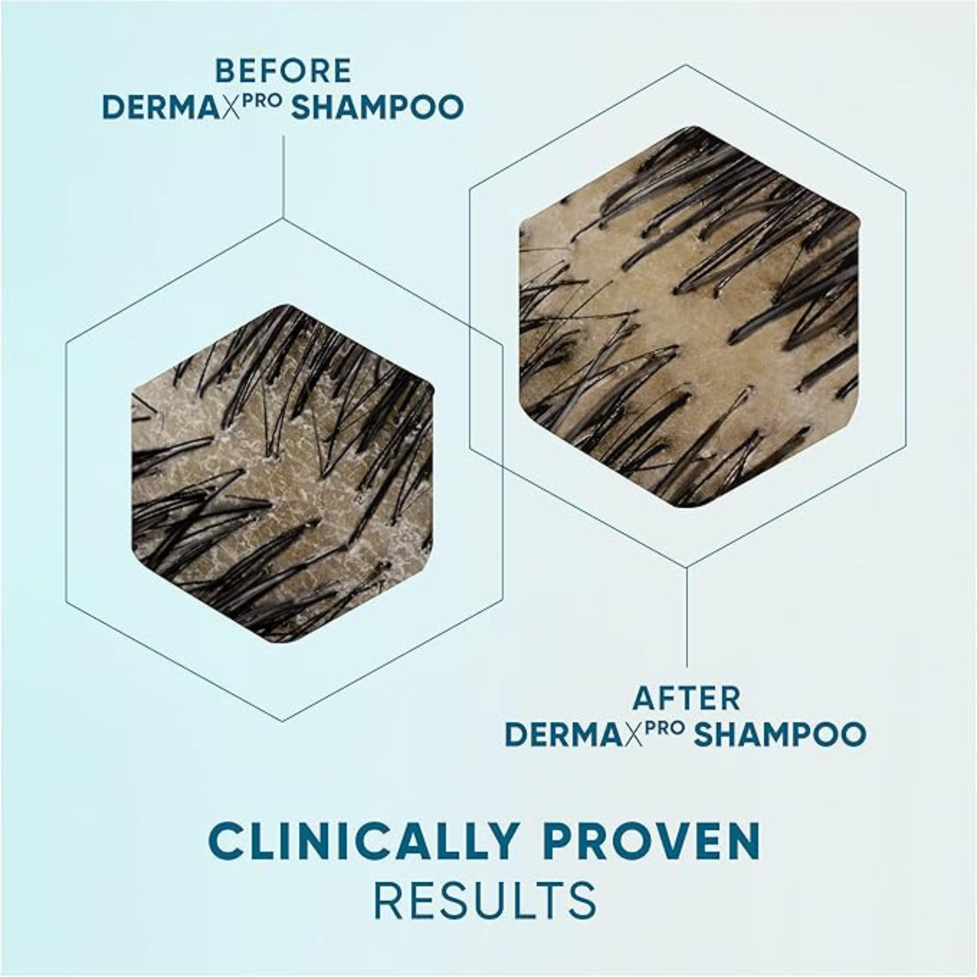 Head & Shoulders DermaX Pro Scalp Hair Revitaliser Anti-Dandruff Shampoo genuine authentic soothing comfort hair Best foreign bathing import UK low price in BD